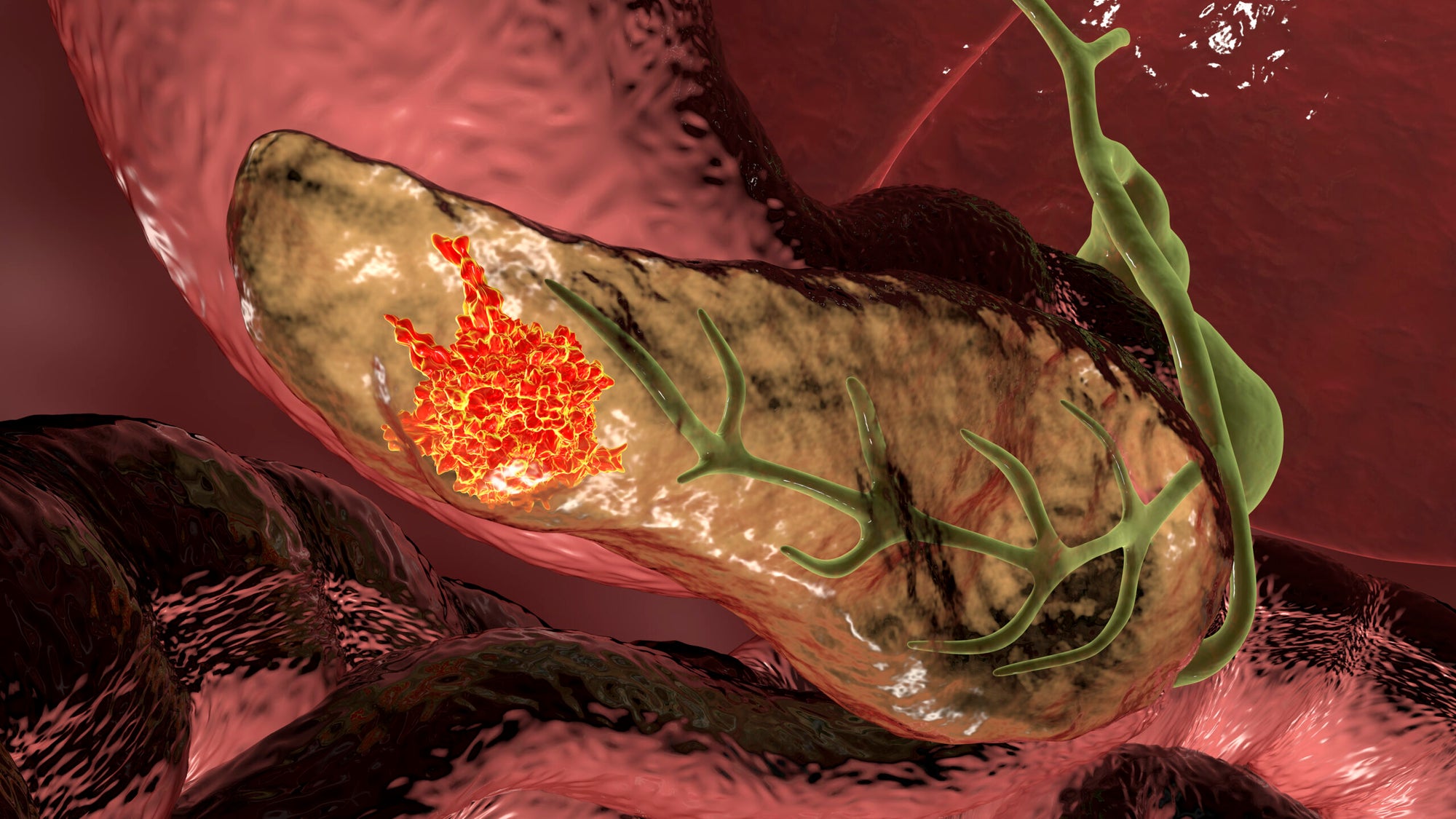 First-ever mRNA vaccine can stop pancreatic cancer in its tracks - The ...