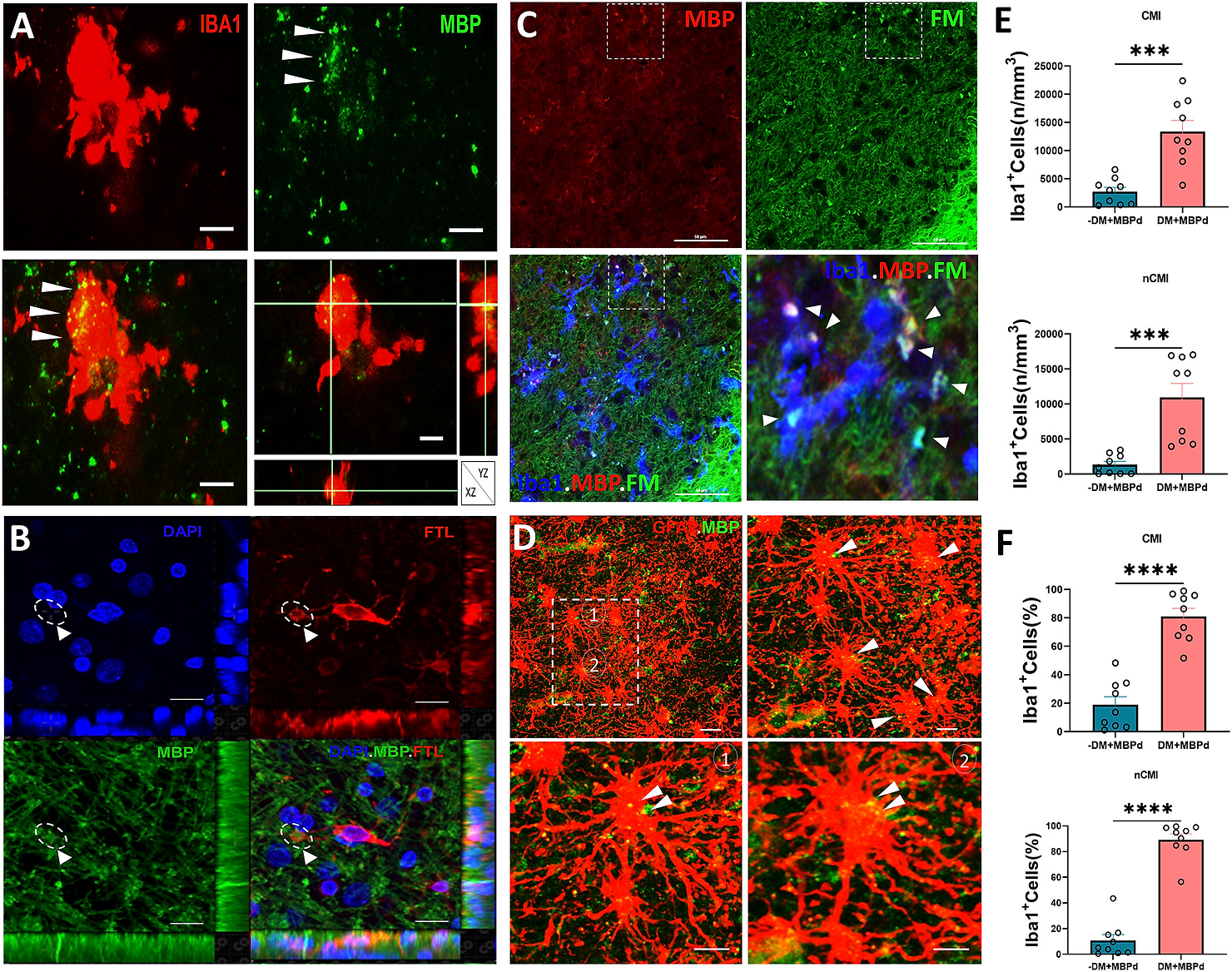 Degenerative microglial (DM) phagocytose myelin debris. A typical Iba1+ DM (red) with a paucity of shrunken processes. Myelin debris (MBPd; green), visualized by staining for myelin basic protein (MBP), was extensively co-localized in the DM soma (merged; arrowheads), as confirmed in the orthogonal views. Scale bars = 20 μm. 