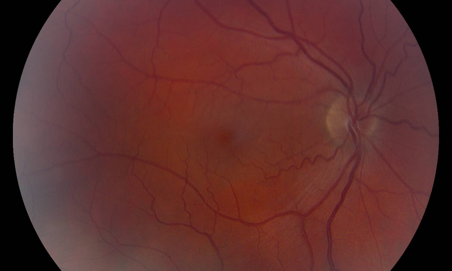 A view of nonarteritic anterior ischemic optic neuropathy, also known as an &quot;eye stroke.&quot; 