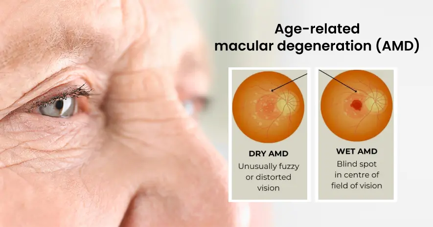 Age-related macular degeneration (AMD) is a leading cause of vision loss among individuals over 65. 