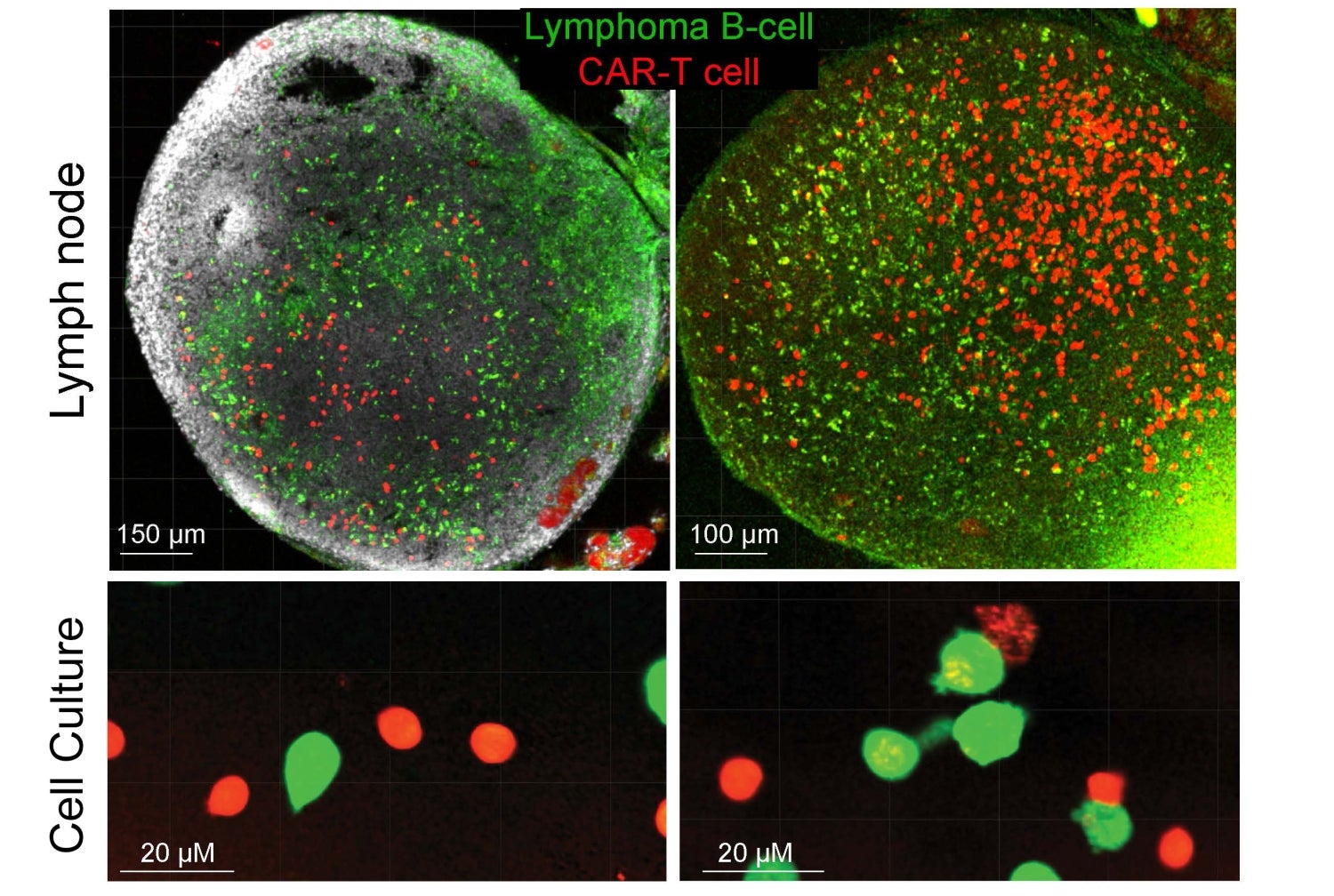 Pretreatment with EZH2 inhibitor (top right) leads to higher recruitment of CAR-T cells (red) into the lymph node tumor compared with control (top left). Pretreatment with EZH2 inhibitor (bottom right) also leads to closer contacts between lymphoma B cells and T cells in culture. 