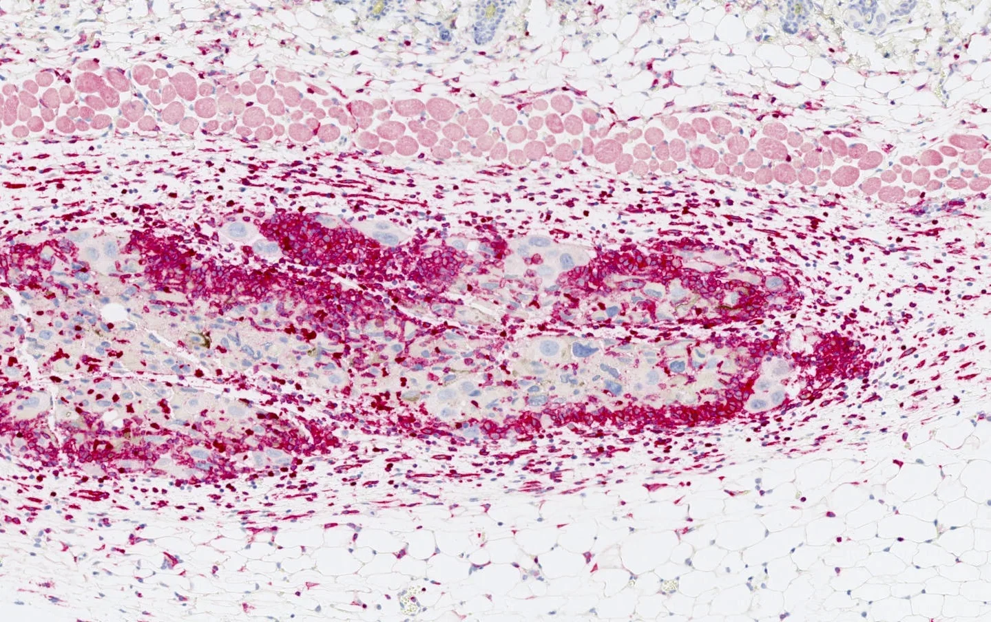 Immune cell infiltrate (in deep red) around senescent cancer cells (large nuclei marked in blue).