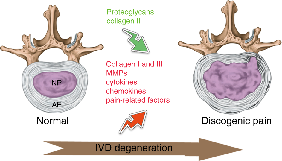 Illustration of degenerative changes in painful intervertebral discs. During IVD degeneration, proteoglycans and collagen II are decreased, while collagen I and III are increased in the extracellular matrix. 