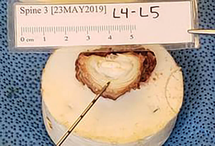 In animal/cadaver studies, ReGelTec researchers were able to dissect the disc following treatment with HYDRAFIL and see the material in the NP.