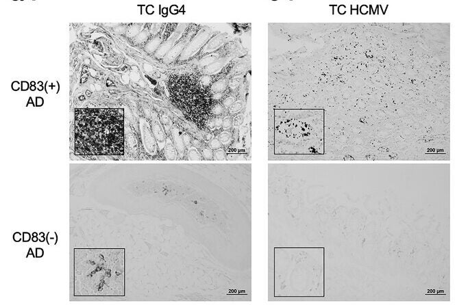 CD83(+) microglia are associated with IgG4 and HCMV in the TC. (A i–ii) Significant association between CD83(+) microglia and IgG4 immunoreactivity in TC.