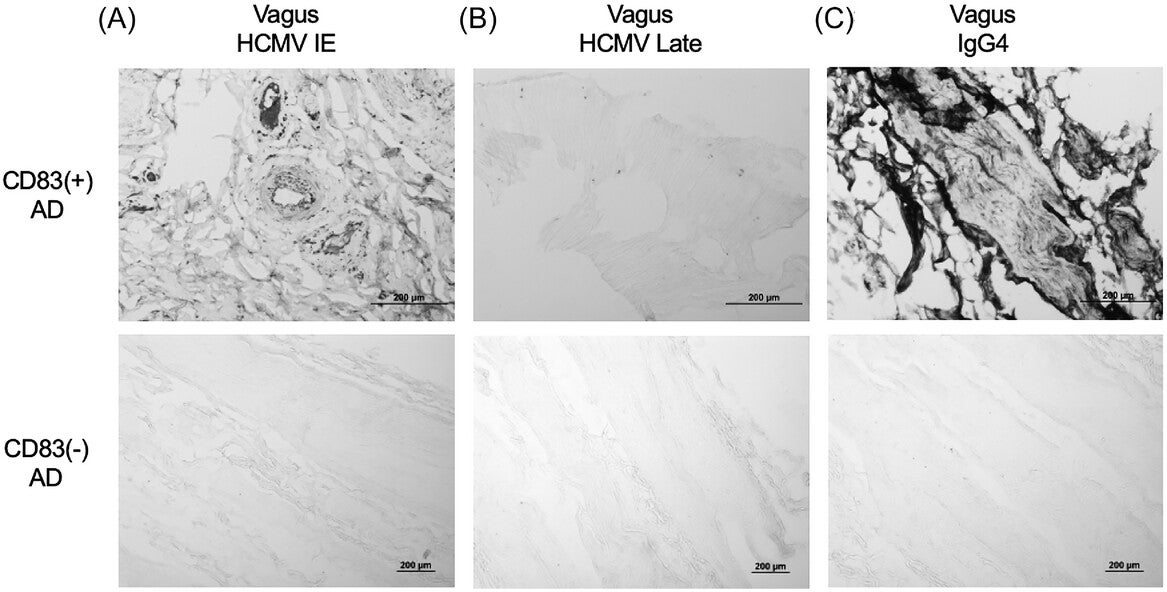 IgG4 and HCMV presence in the vagus nerve of AD subjects with CD83(+) microglia. (A–B) HCMV and (B) IgG4 immunoreactivity in the vagus nerve of AD subjects with and without CD83(+) microglia. Representative photomicrographs shown. AD, Alzheimer's disease; HCMV, human cytomegalovirus; IgG4, immunoglobulin G4. 