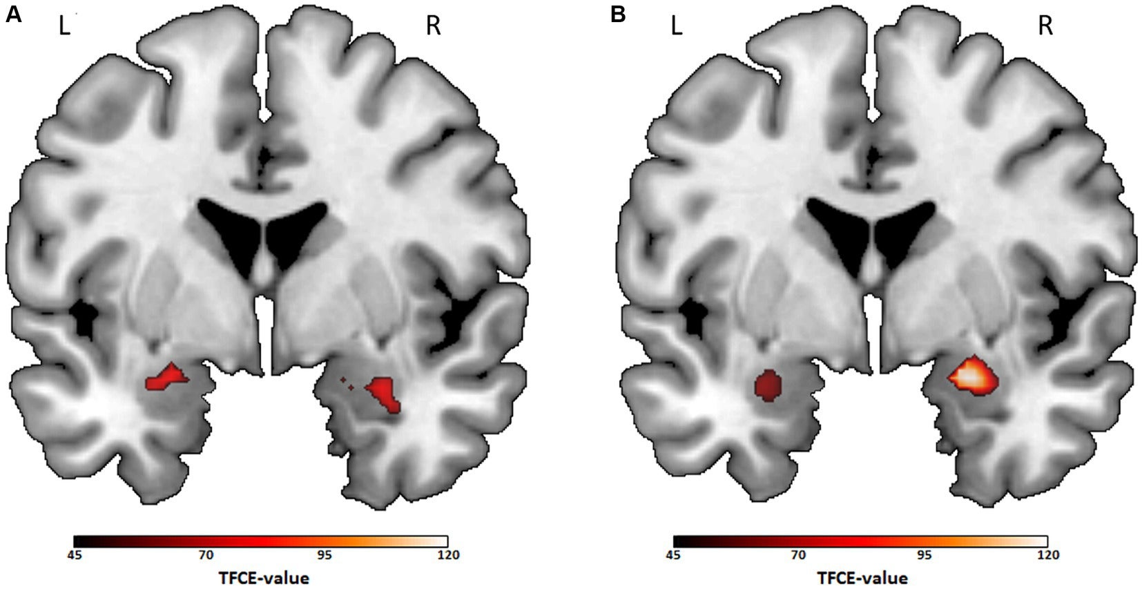 Bilateral amygdala activation for post-hoc comparisons between action vs. crime/thriller preference and comedy vs. crime/thriller preference.