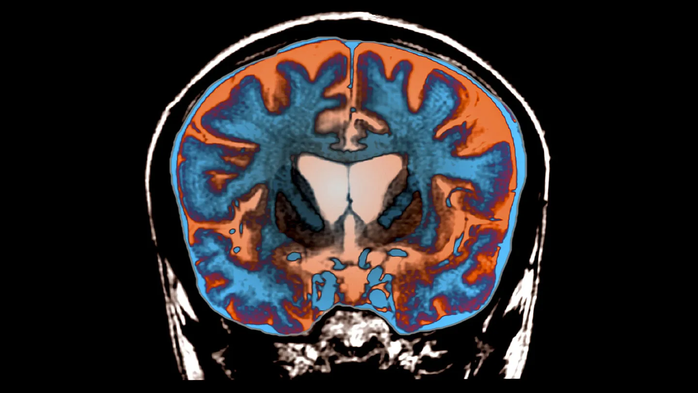 New findings reveal the atomic structure of Huntington’s disease protein aggregates, offering insights into their role in neurodegeneration and potential therapies.