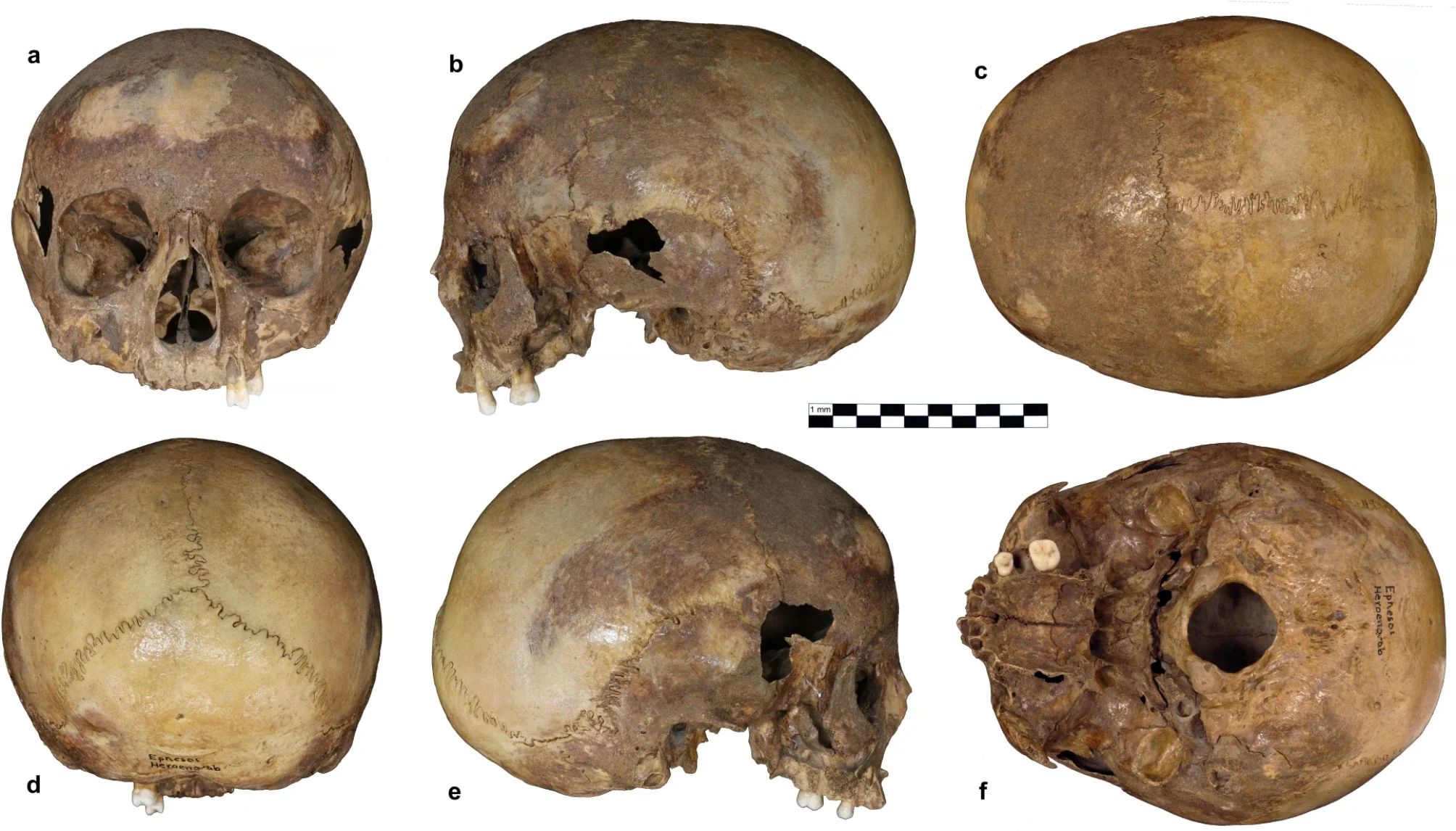 The cranium from the Octagon in Ephesos. Six norm views: (a) frontal, (b) lateral sinistra, (c) vertical, (d) occipital, (e) lateral dextra, (f) basal.