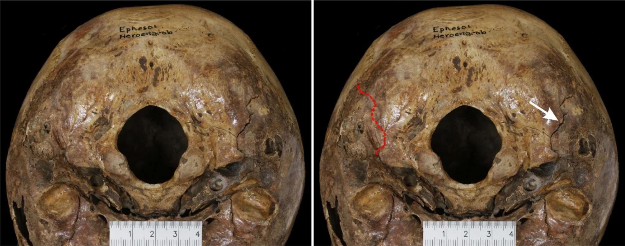 The completely obliterated left occipitomastoid suture of the Octagon-cranium. On the left panel, the original status is shown. On the right panel, the position of the right occipitomastoid suture is marked with a white arrow, and the tentative pathway of the left occipitomastoid suture (red curved line) was copied from the right side and mirrored.