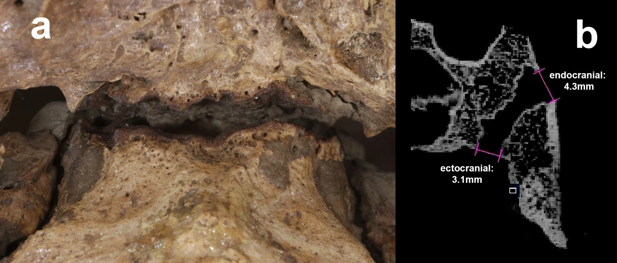 The widely open sphenobasilar synchondrosis, (a) ectocranial surface of the original; (b) cut through µCT slice representing the midsagittal plane with endo and ectocranial measurements.

